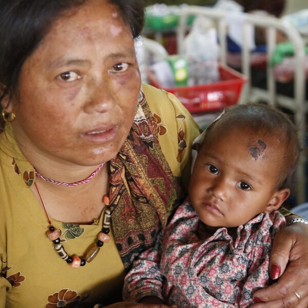 A woman holding a young child on her lap in what appears to be a medical setting with hospital beds and supplies in the background. Both have visible skin conditions. The woman is wearing a yellow floral top with a patterned shawl and beaded necklace, and the child is in a patterned shirt. They are looking directly at the camera with neutral expressions.